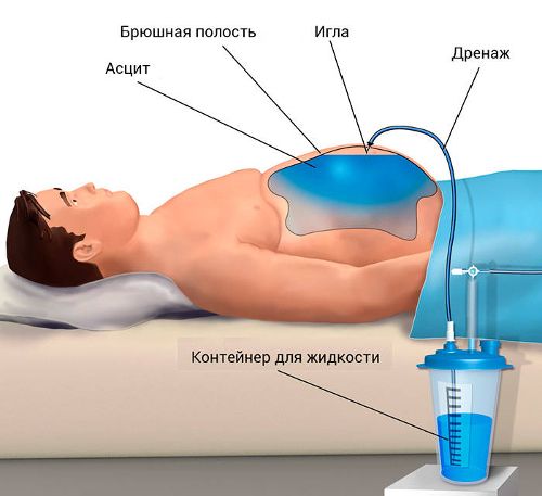 Парацентез