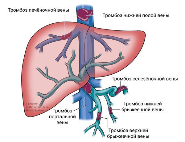 Тромбоз вен Тромбоз вен