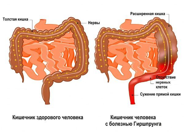 Кишечник при болезни Гиршпрунга Кишечник при болезни Гиршпрунга