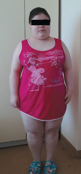 Пациентка с синдромом Барде — Бидля [22]