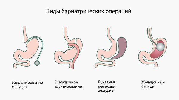 Виды бариатрических операций Виды бариатрических операций