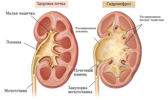Здоровая почка и гидронефроз Здоровая почка и гидронефроз