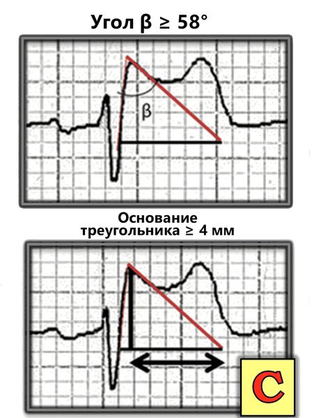 Дополнительные диагностические критерии по Коррадо [10]
