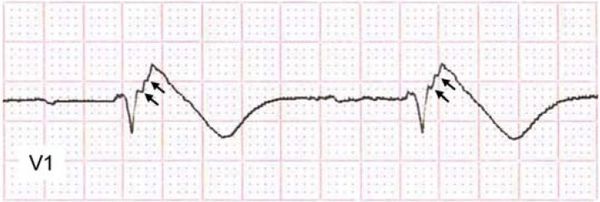 Фрагментированный комплекс QRS (fQRS) [12]