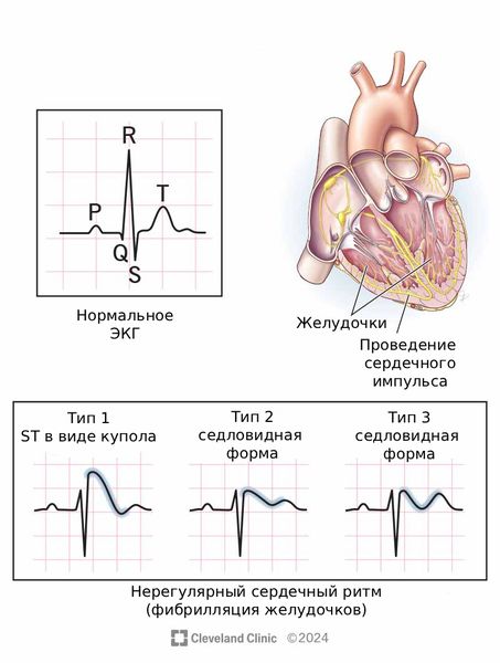 Синдром Бругада
