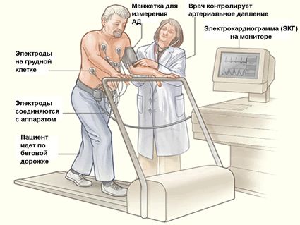 Тест с физической нагрузкой на беговой дорожке