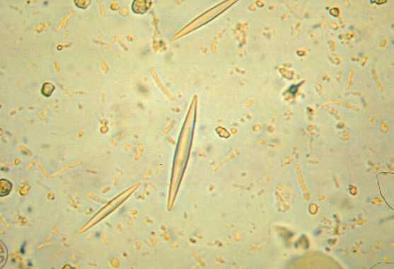 Мокрота под микроскопом фото