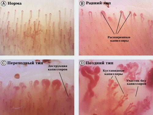 Капилляроскопическая картина при системной склеродермии [20]