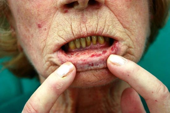 Телеангиэктазии на слизистой полости рта [18]