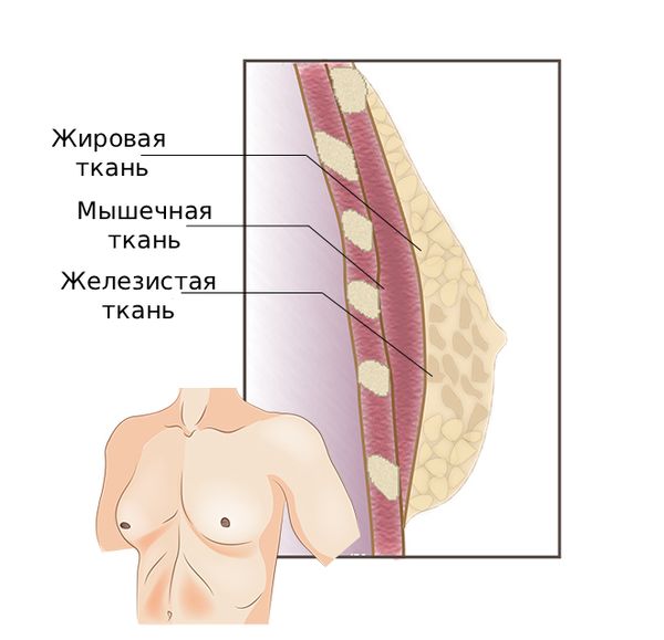 Гинекомастия Гинекомастия