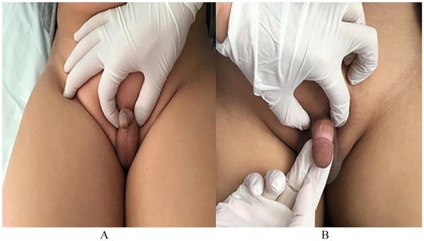 Микропения: до и после лечения [16]