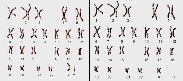 Обычный мужской кариотип и кариотип при синдроме де ля Шапеля Обычный мужской кариотип и кариотип при синдроме де ля Шапеля