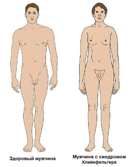 Синдром Клайнфельтера Синдром Клайнфельтера