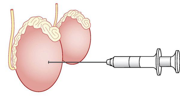 Забор семенной жидкости Забор семенной жидкости