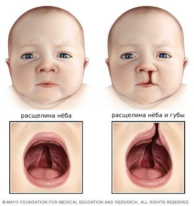 Расщелины верхнего нёба и губы