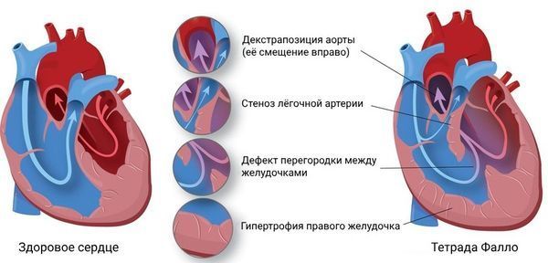 Сердце в норме и при тетраде Фалло