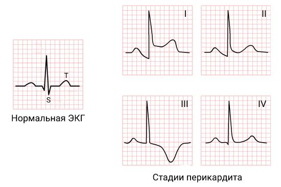 Подъём сегмента S—Т 