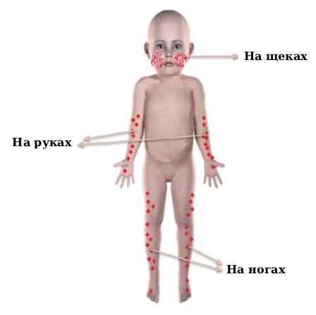 Расположение сыпи при синдроме Джанотти — Крости [24]