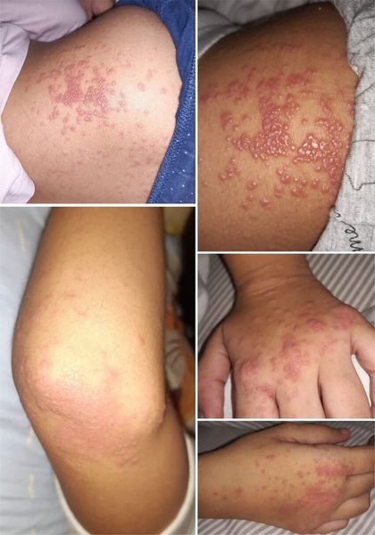 Сыпь при синдроме Джанотти — Крости [25]