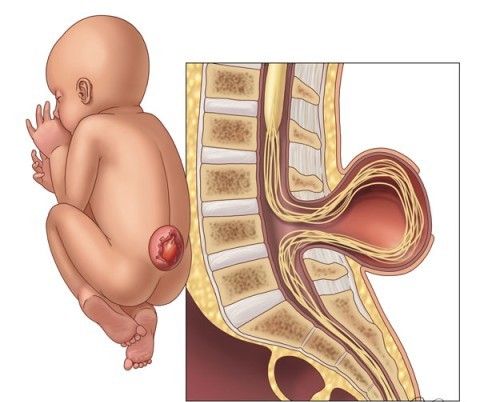 Менингоцеле (спинномозговая грыжа)