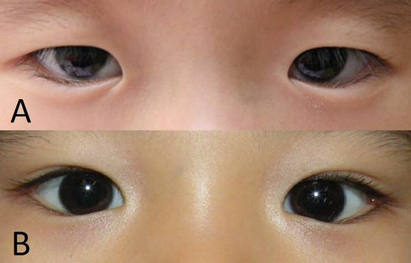 Типы эпикантуса [22]