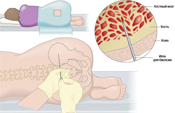 Пункция костного мозга