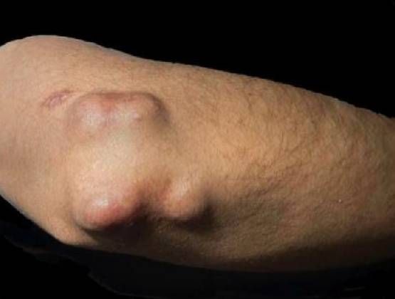 Ревматоидные узелки на локте [24]