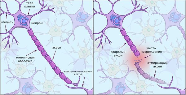 Разрушение нервных клеток