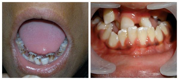 Аномалии зубов при синдроме Гольденхара
