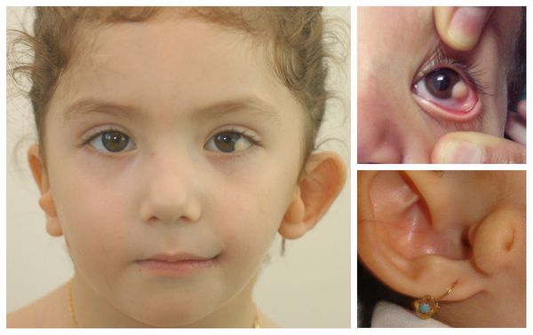 Лицевые аномалии при синдрома Гольденхара: недоразвитие челюсти, лопоухость, дермоидная киста глаза и околоушной вырост