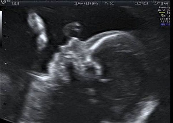 Микрогнатия на УЗ-снимке (второй триместр беременности)