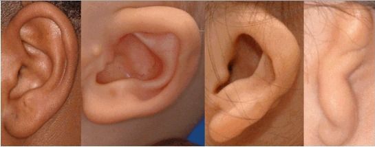 Варианты аномалии ушных раковин