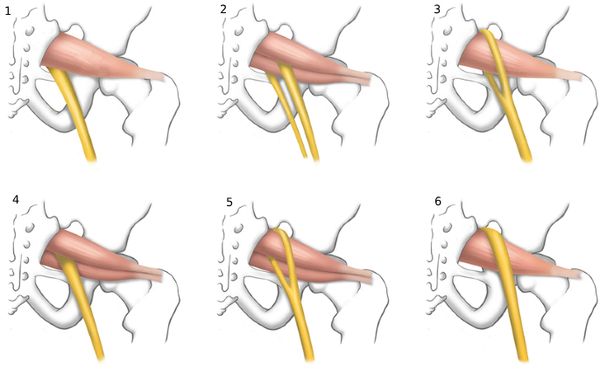 Виды взаимоотношений между седалищным нервом и грушевидной мышцей