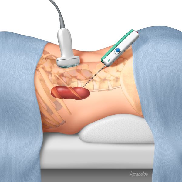 Биопсия почки