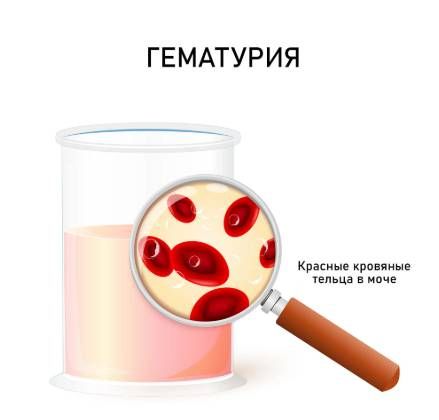 Гематурия