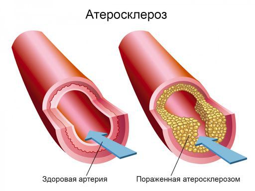ateroskleroz s