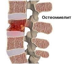 Остеомиелит