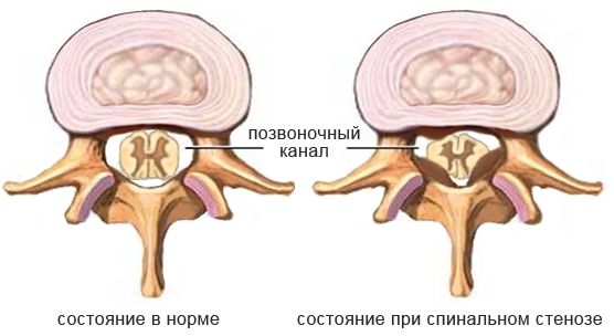Стеноз позвоночного канала
