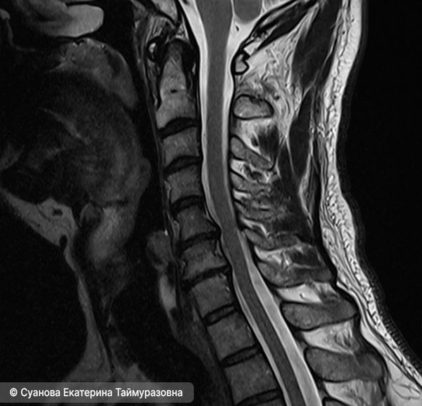 Выпрямление шейного лордоза с грыжей и протрузиями