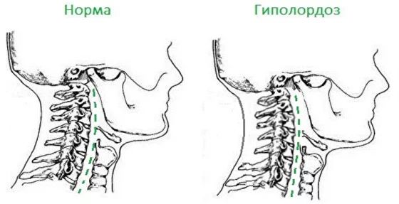 Выпрямление шейного лордоза