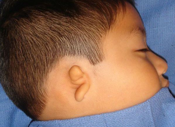 Недоразвитая ушная раковина при синдроме Конигсмарка