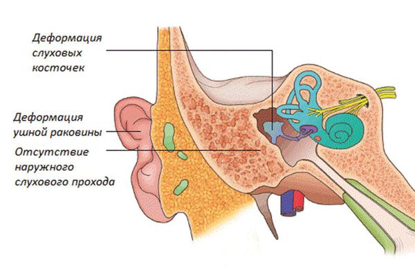 Строение уха при синдроме Конигсмарка