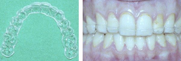 Окклюзионные шины [17]