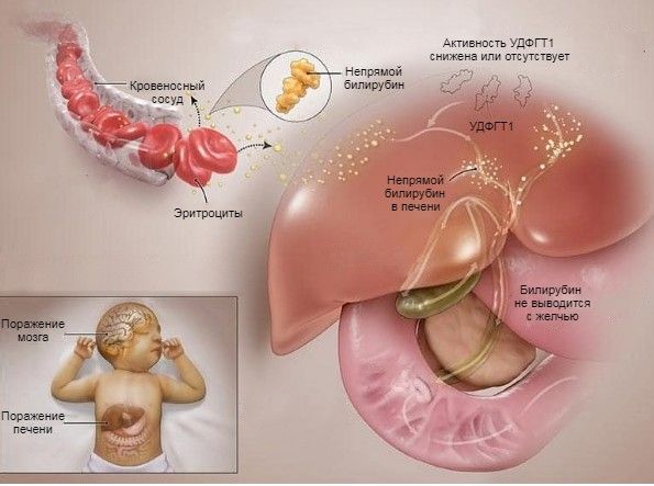 Патогенез синдрома Криглера — Найяра