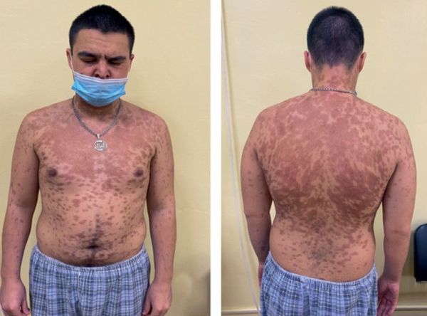 Благоприятный исход синдрома Лайелла. Остаточная пигментация [23]