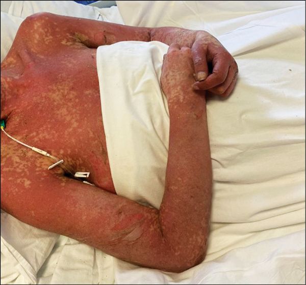 Диффузно-красное поражение кожи при синдроме Лайелла [22] (нажмите на изображение, чтобы увидеть его)