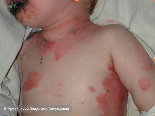 Мишеневидные элементы на руках, выраженные поражения слизистых (нажмите на изображение, чтобы увидеть его) Мишеневидные элементы на руках, выраженные поражения слизистых (нажмите на изображение, чтобы увидеть его)
