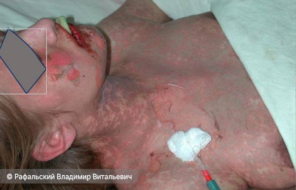 Отслаивание кожи при синдроме Лайелла (нажмите на изображение, чтобы увидеть его) Отслаивание кожи при синдроме Лайелла (нажмите на изображение, чтобы увидеть его)