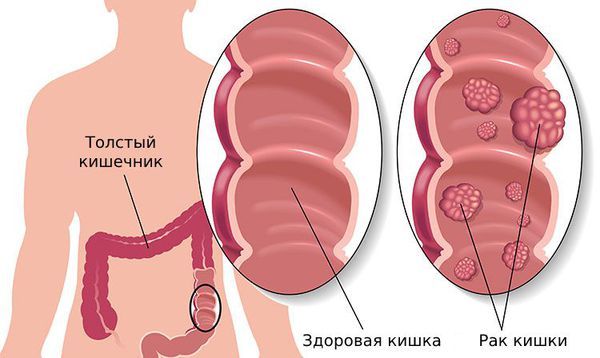Рак толстой кишки Рак толстой кишки