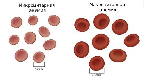 Микроцитарная и макроцитарная анемии
